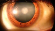 Cataract_in_human_eye