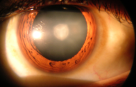 Cataract_in_human_eye